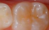 Sealant-Before - Pediatric Dentist in Manitowoc, WI