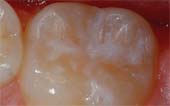 Sealant-After - Pediatric Dentist in in Manitowoc, WI